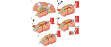 Stroke Treatment